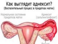 Застудила придатки: симптомы