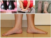 Flat feet - causes, symptoms in adults, types, degrees, treatment and prevention of flat feet